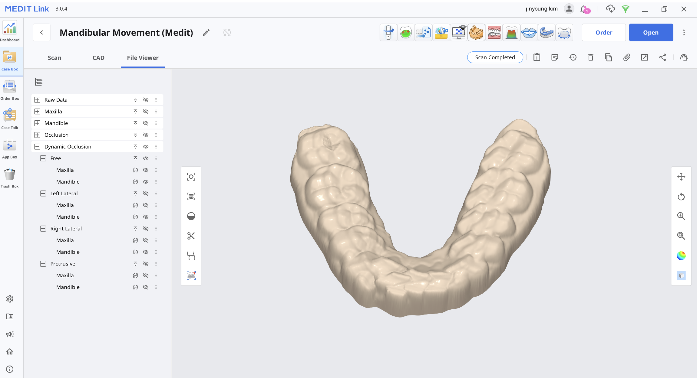 Usando Dados de Oclusão Dinâmica para Criar uma Tala Dentária Central