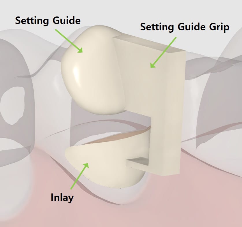 Designing-Cervical-Inlay-1.jpg