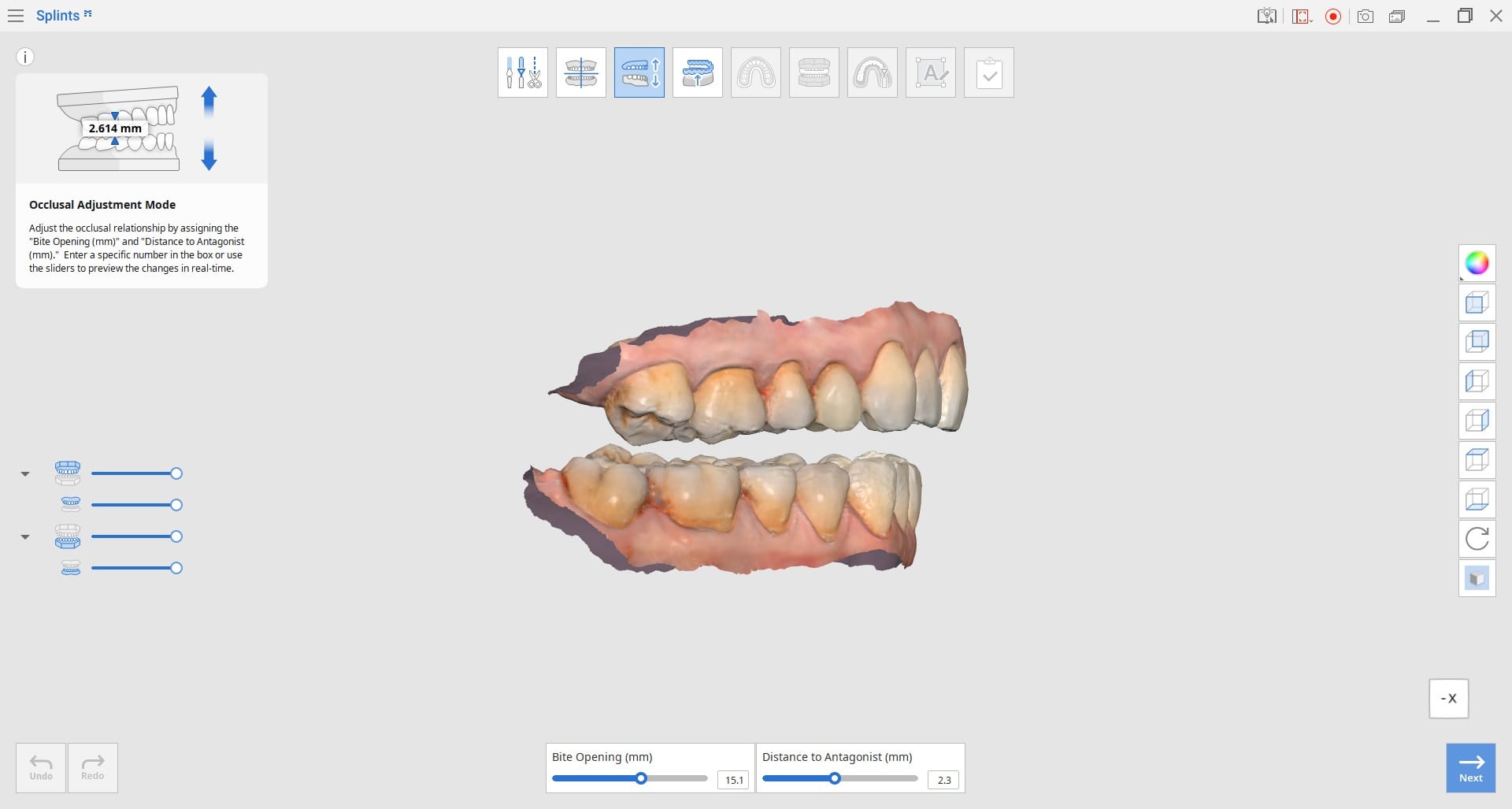 Occlusal-Adjustment-Mode-1.jpg