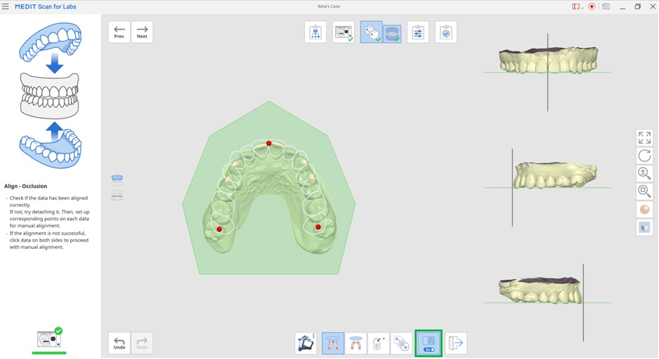 Align with Occlusal Plane-4.jpg