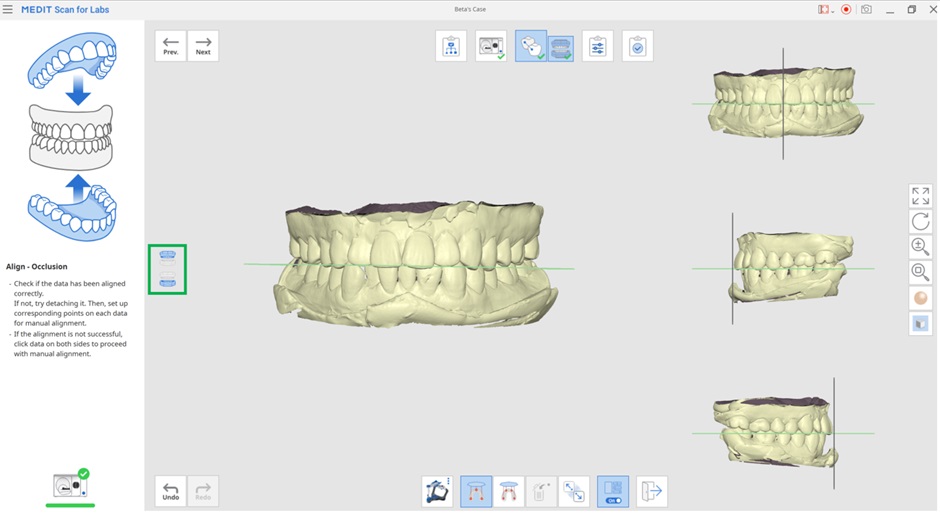 Align with Occlusal Plane-5.jpg