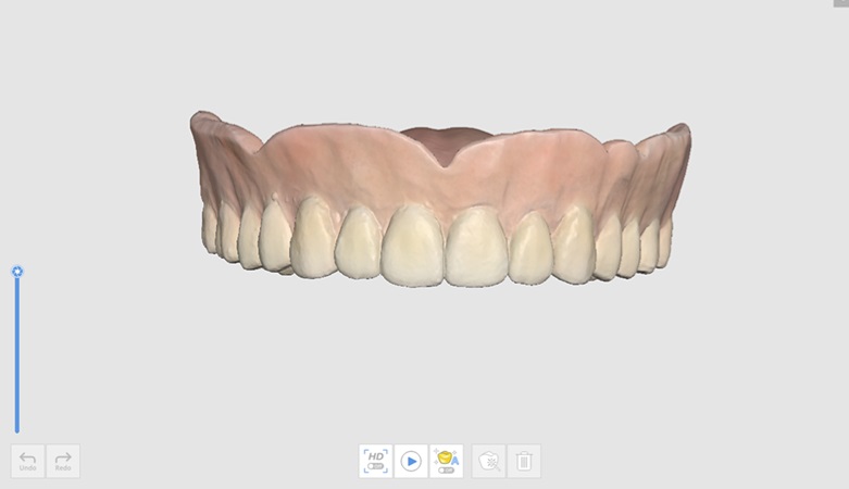 Maxillary Denture Stage.jpg