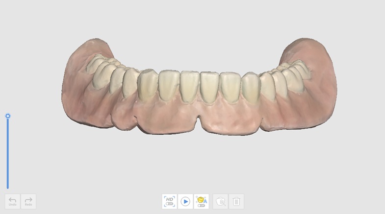 Mandibular Denture Stage.jpg