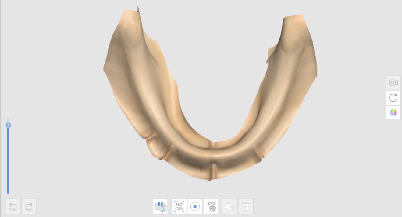 Implant Supported Denture-1.jpg