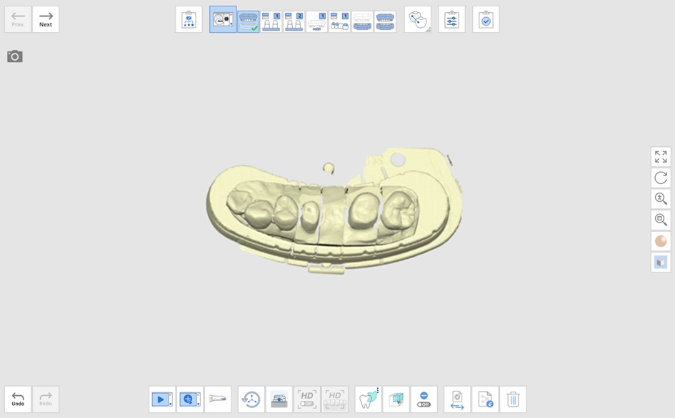 maxillary wax-up 3.jpg
