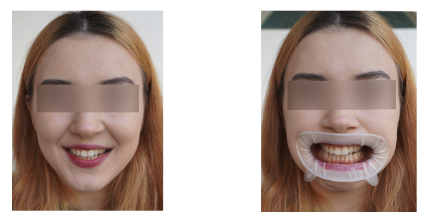 Smiling_and_retracted.png