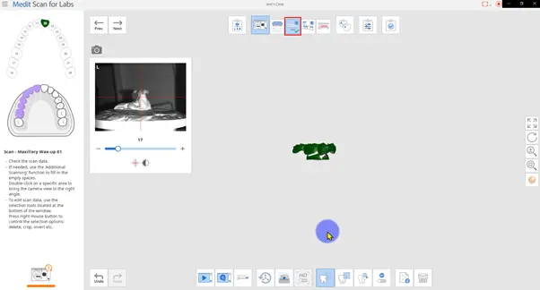 Scanning the outer surface of the crown from the model scanner.webp