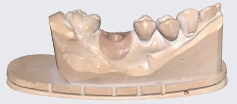 Remove Base from Gingiva Scan 2.jpg
