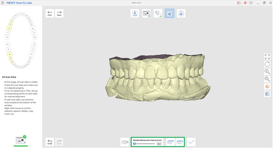 Adjust Occlusion Height-2.jpg