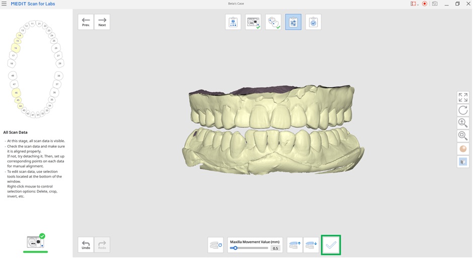 Adjust Occlusion Height-3.jpg