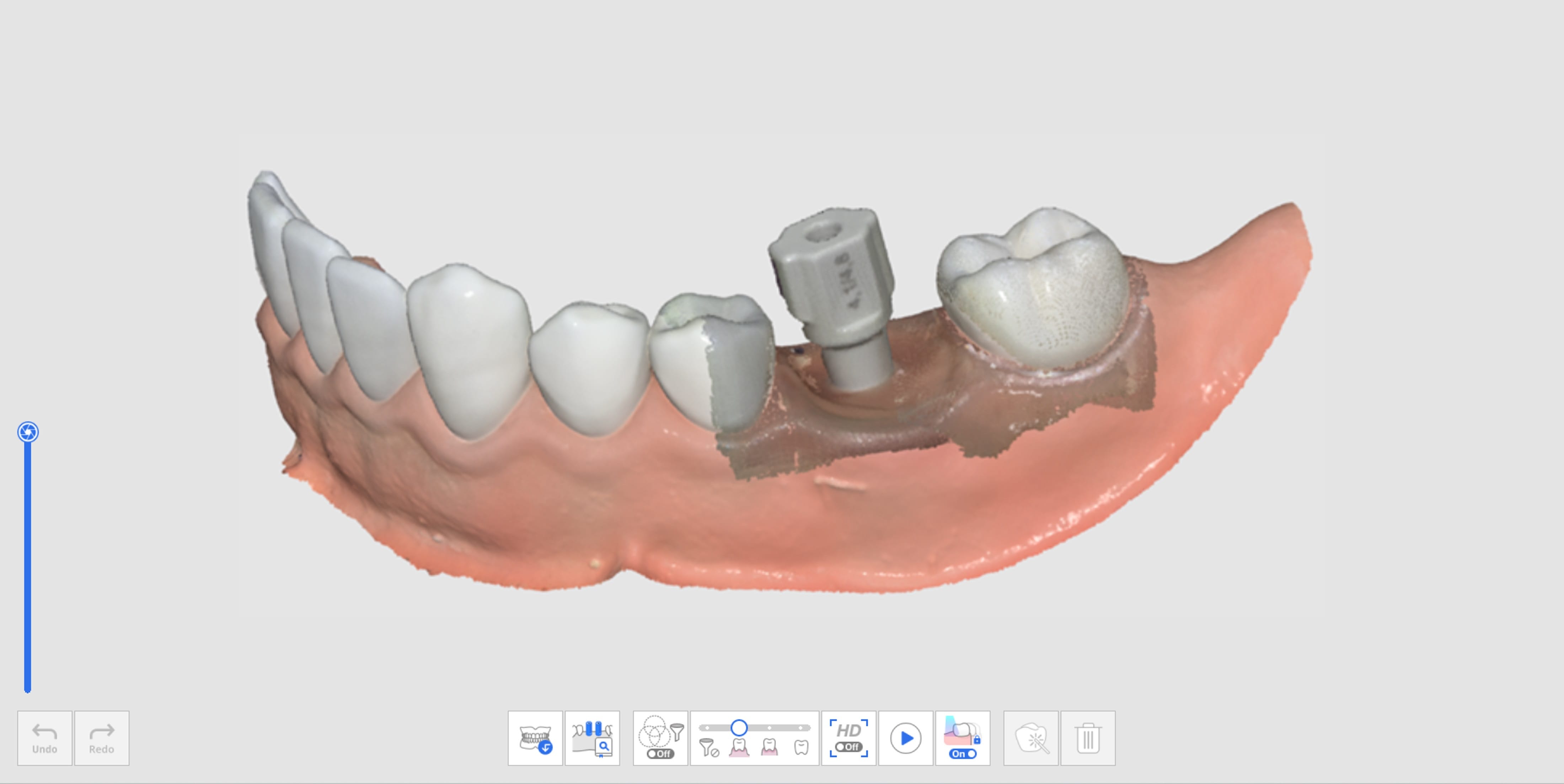 Mandibular Scan Body Stage.jpg