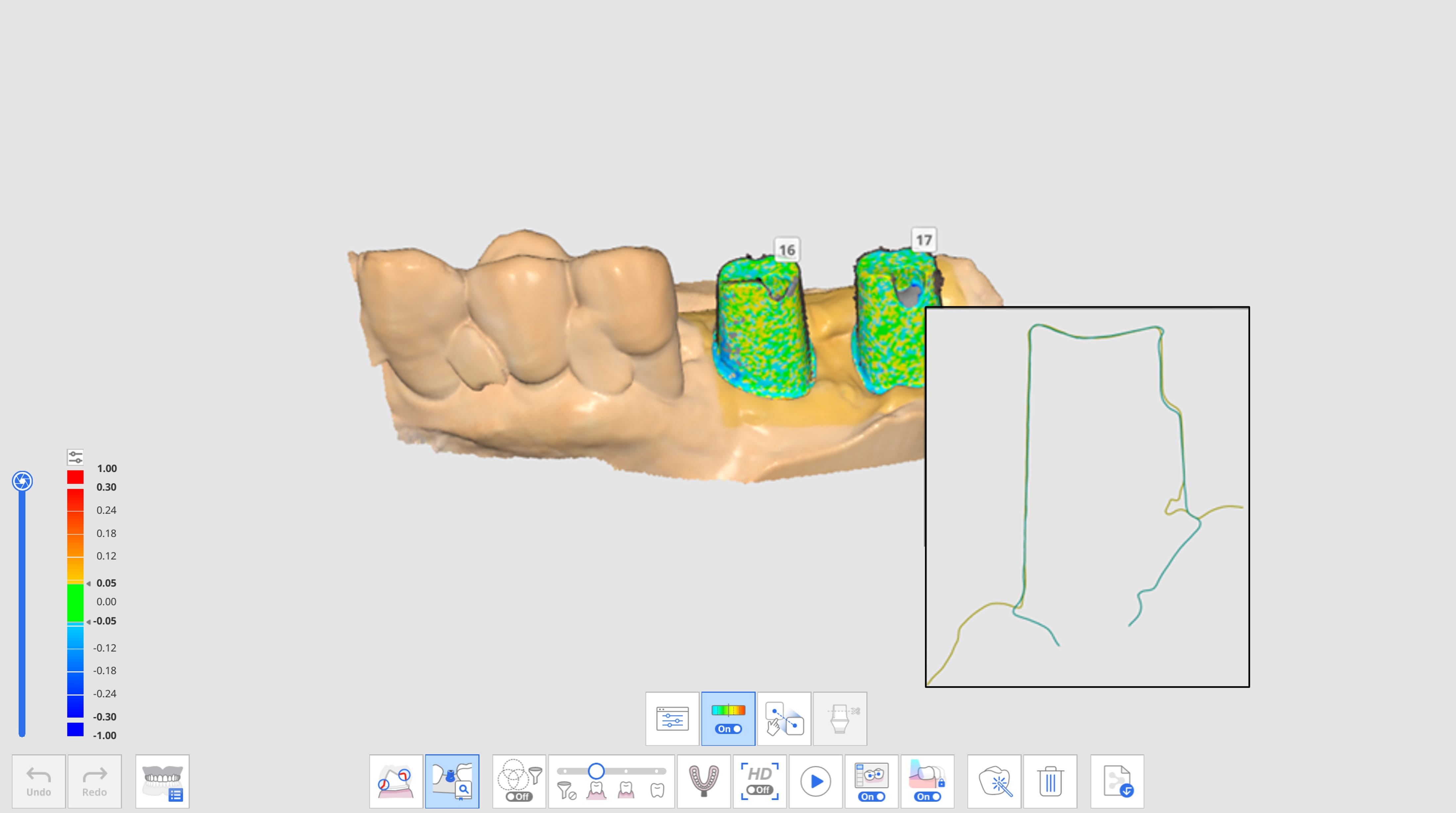 AI Abutment Matching-2.jpg