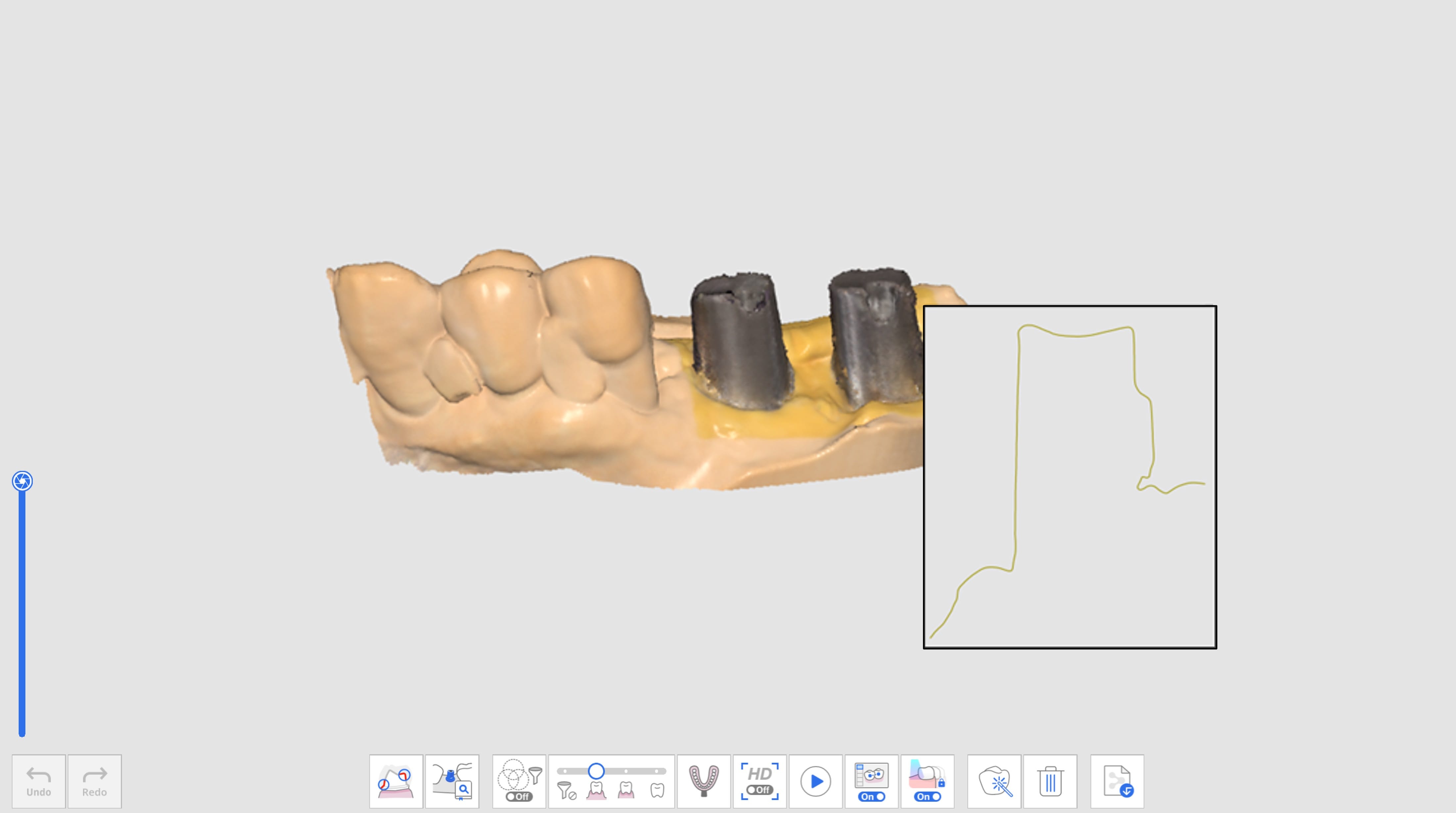 AI Abutment Matching-1.jpg