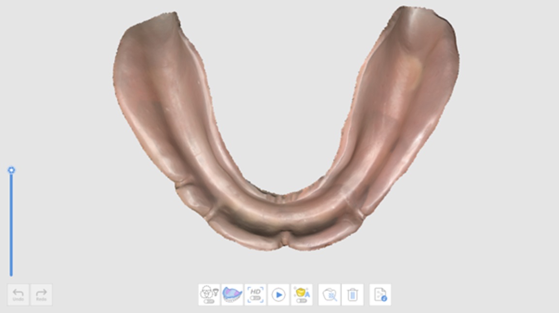Edentulous Mandible Stage.jpg