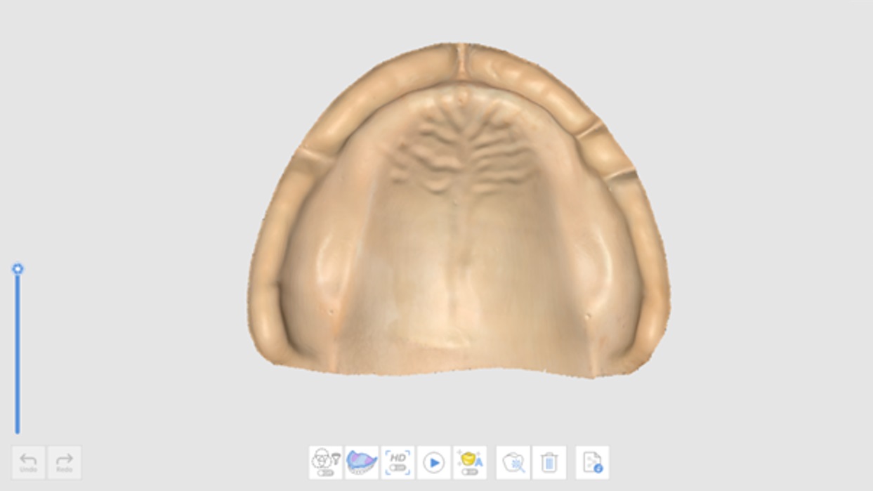 Edentulous Maxilla Stage.jpg