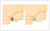 fill_major_holes.png