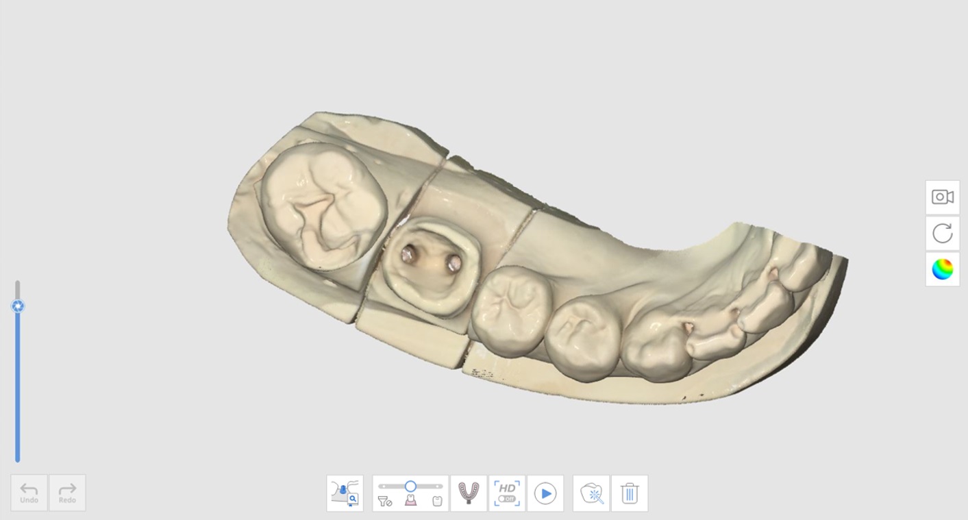 How to Utilize Impression Scan for Post & Core Case-2.jpg