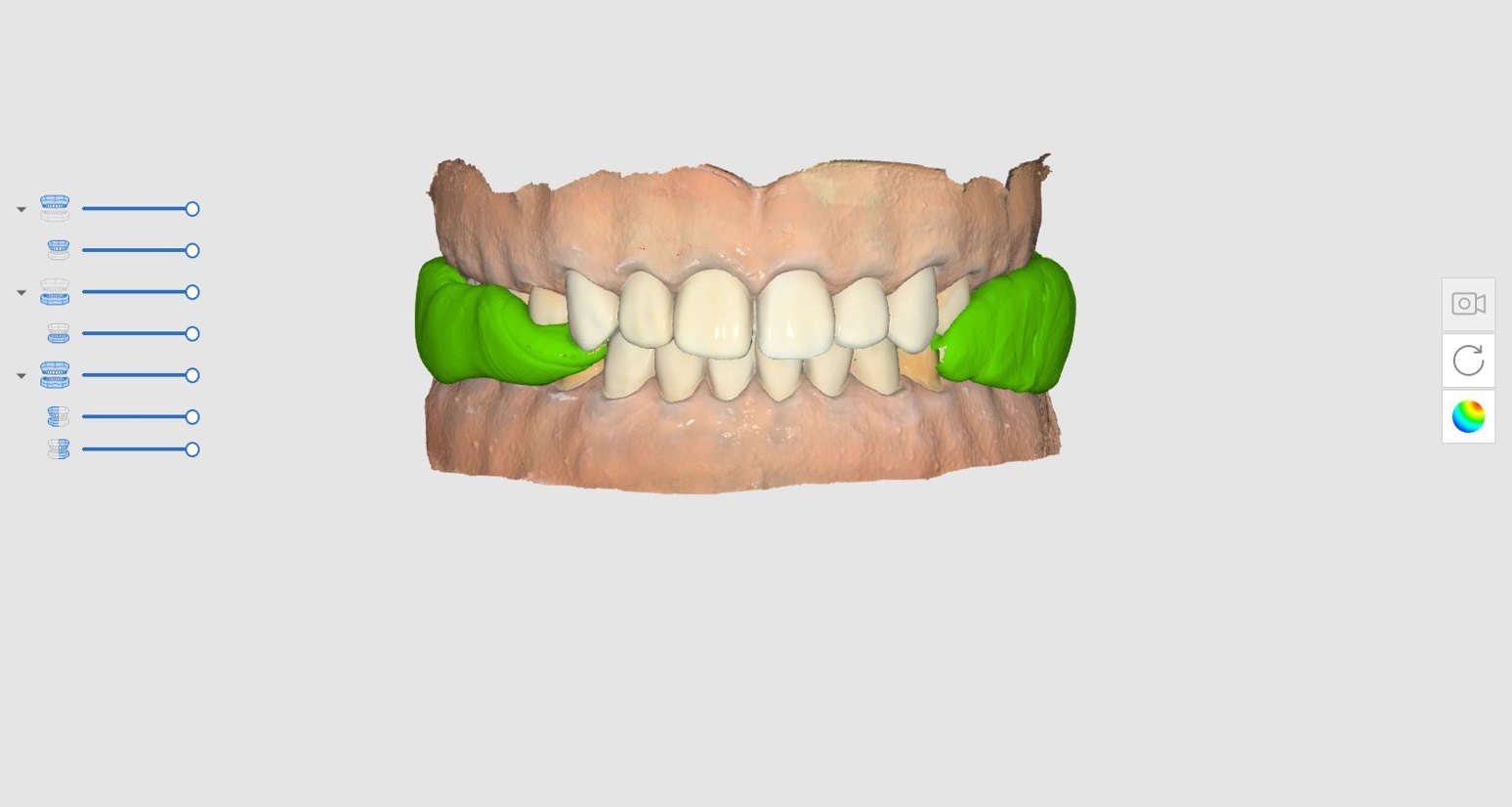 How to Utilize Impression Scan for Occlusion Case-3.jpg