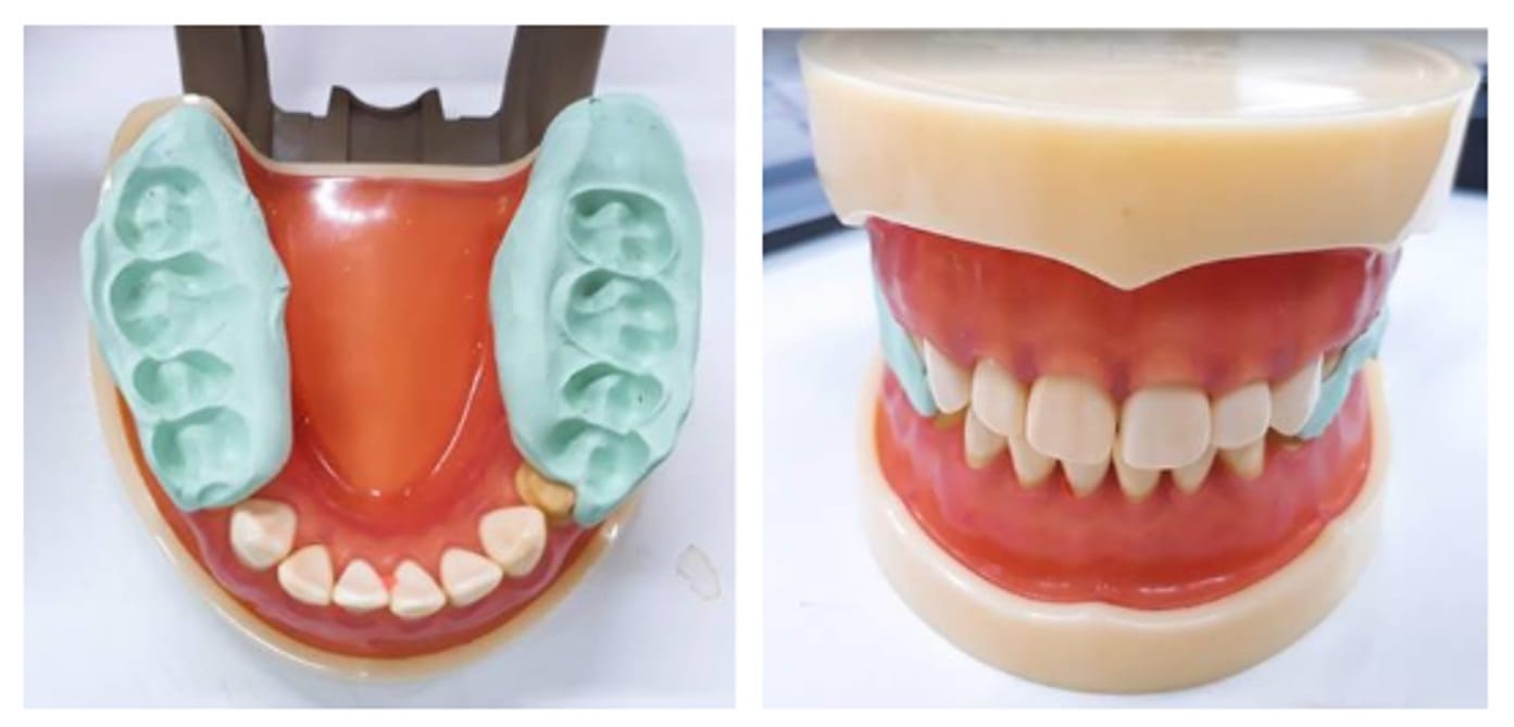 How to Utilize Impression Scan for Occlusion Case-1.jpg