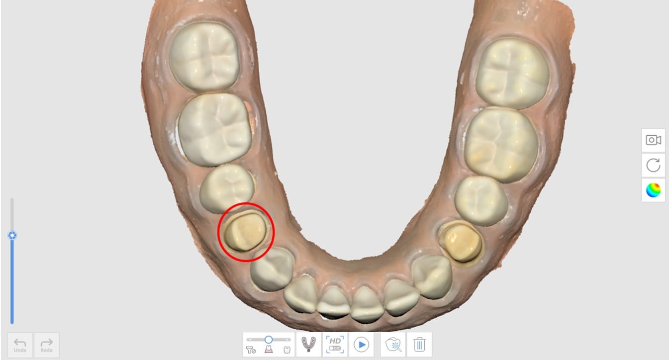 How to Utilize Impression Scan for Margins-1.jpg