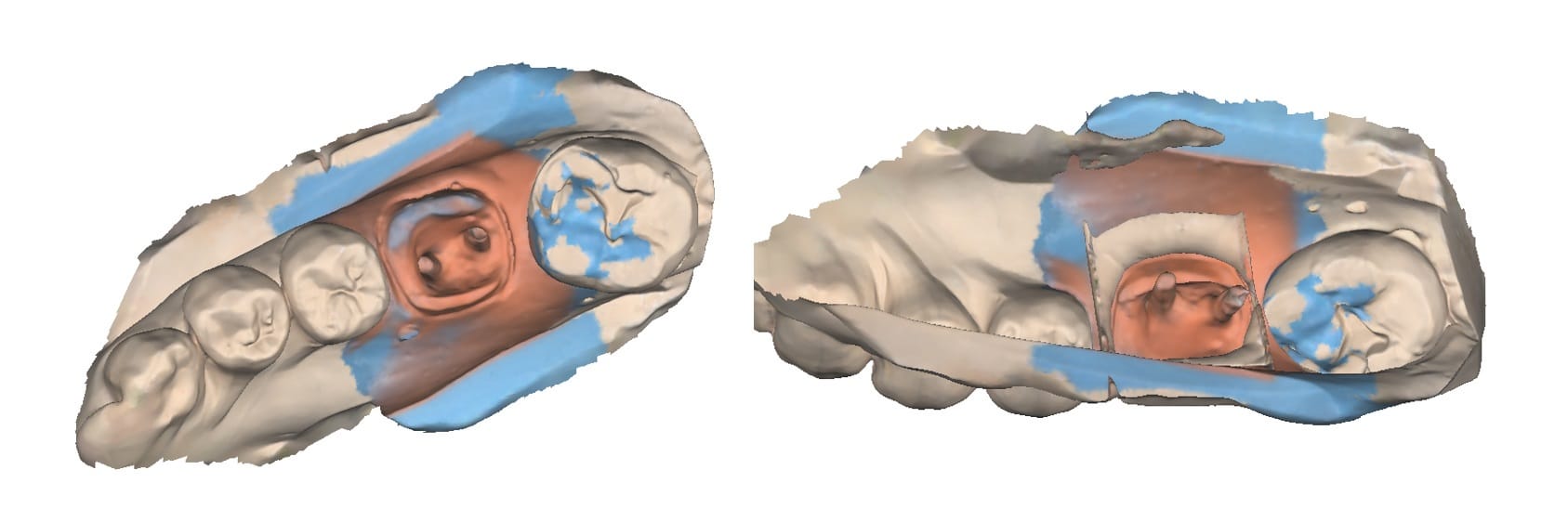 How to Utilize Impression Scan for Post & Core Case-4.jpg