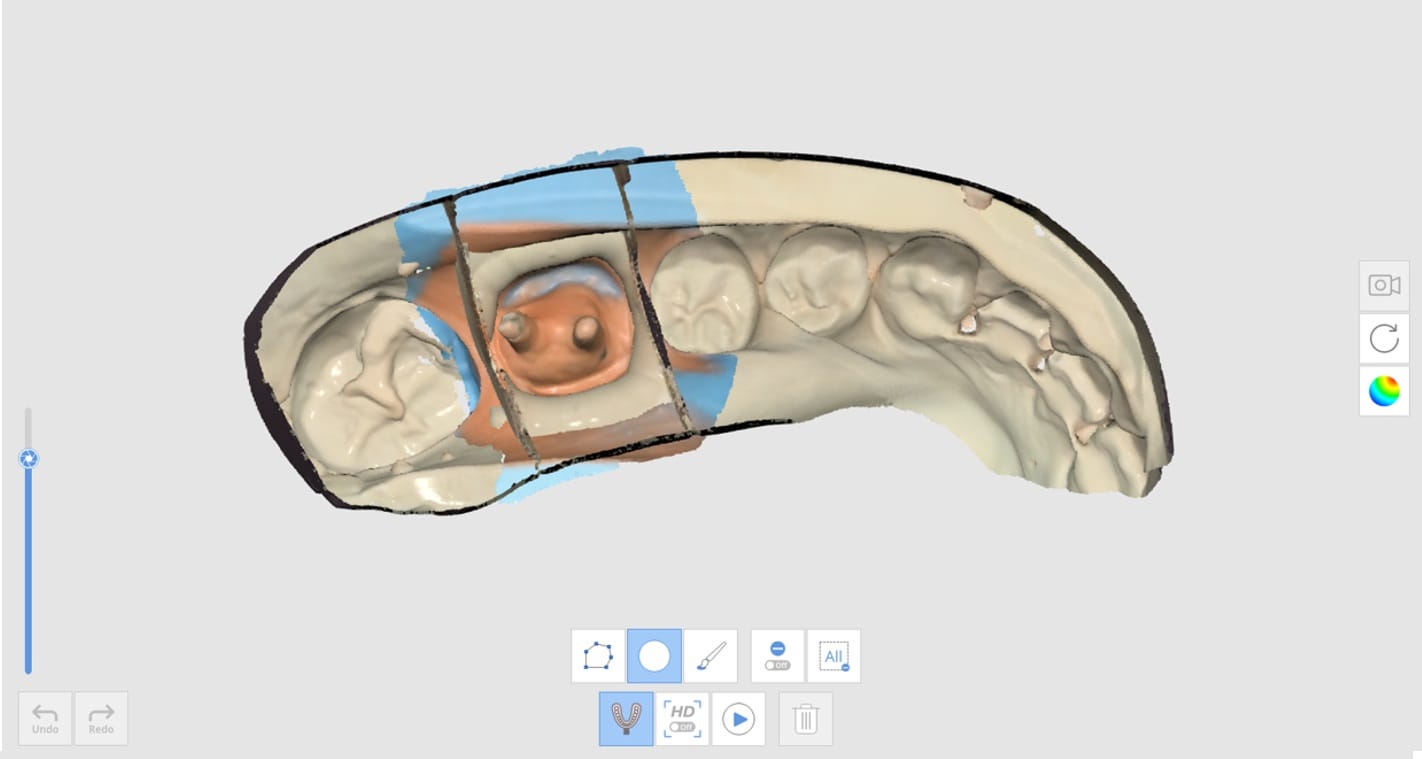 How to Utilize Impression Scan for Post & Core Case-3.jpg