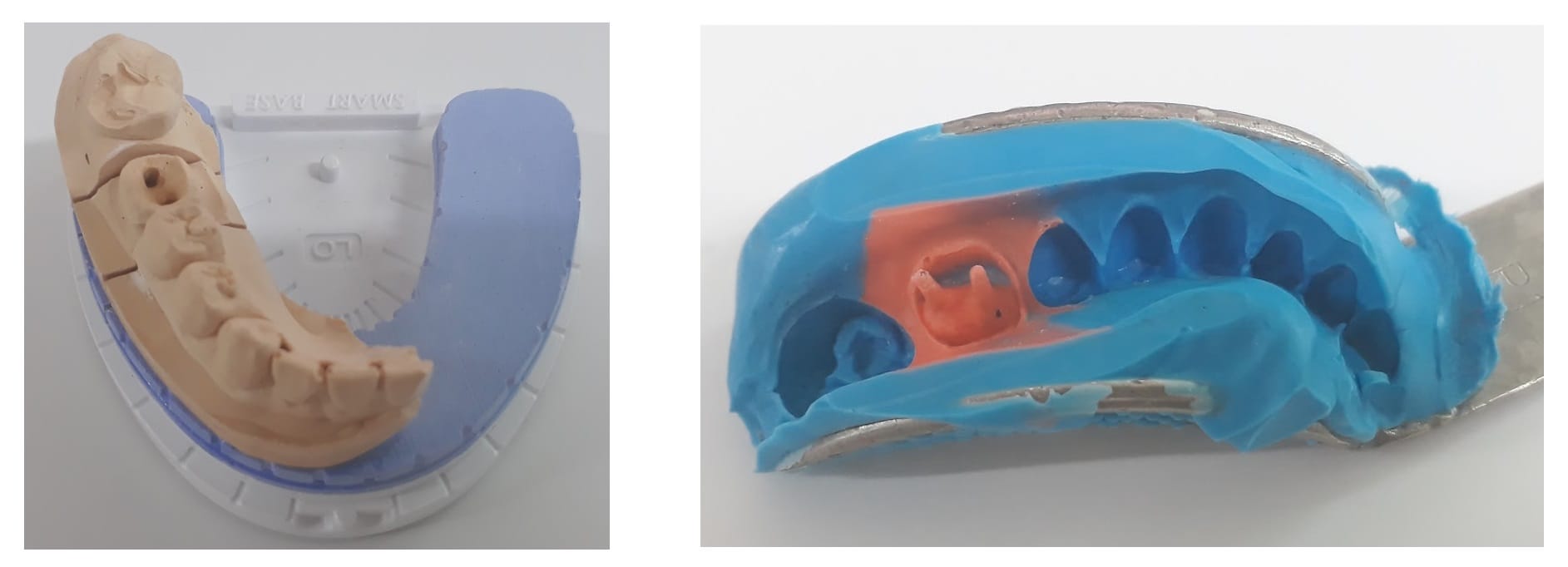 How to Utilize Impression Scan for Post & Core Case-1.jpg