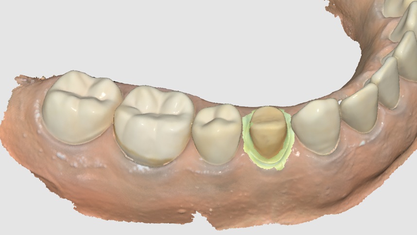 How to Utilize Impression Scan for Margins-4.jpg