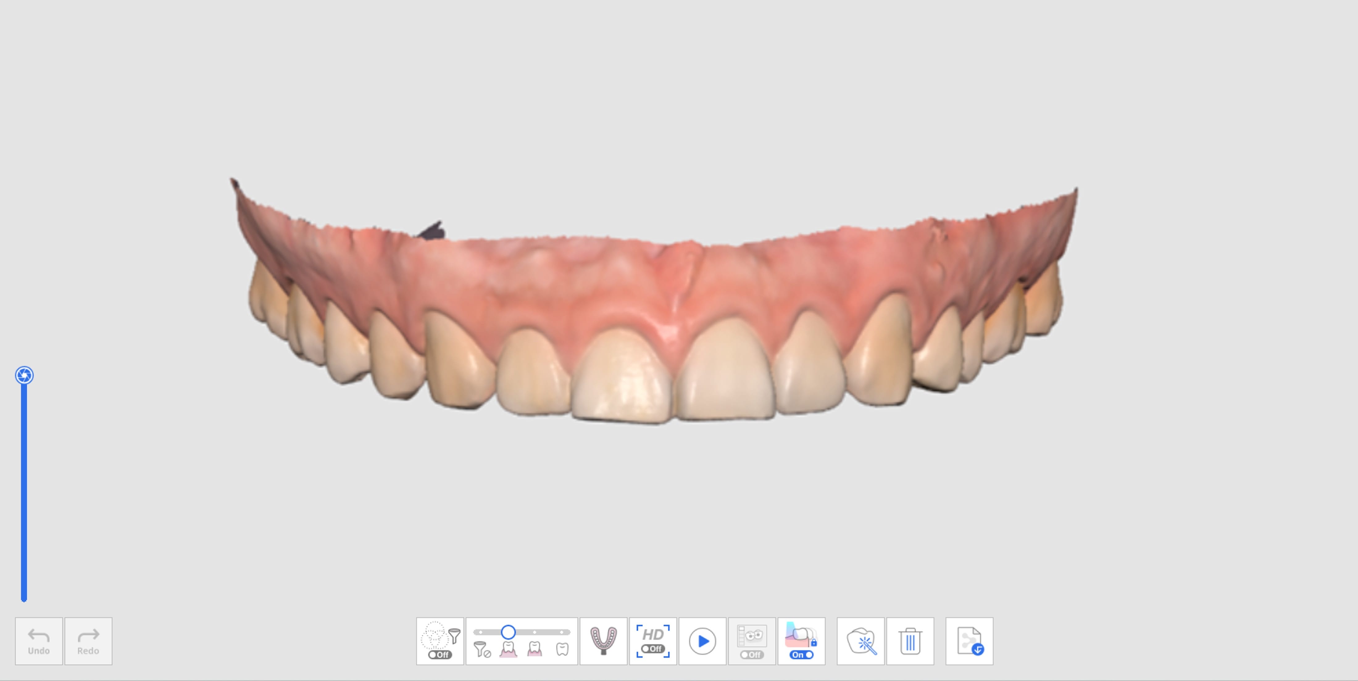 Pre-Op for Maxilla Stage.jpg