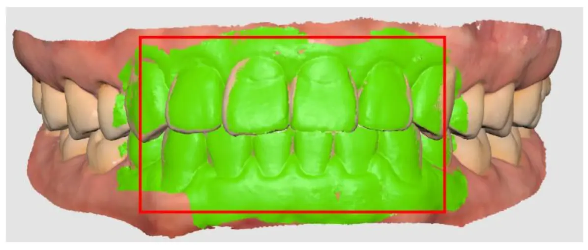 During occlusion 2.webp
