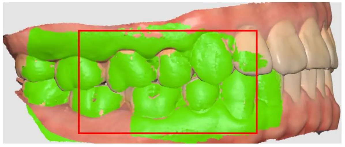 During occlusion 3.webp