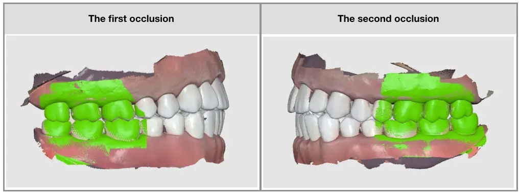 Occlusal scan 2.webp