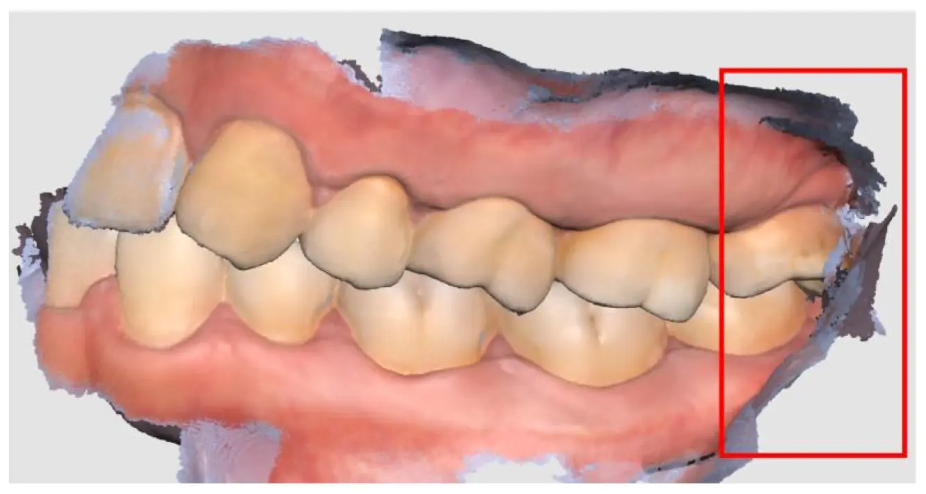 During occlusion 1.webp