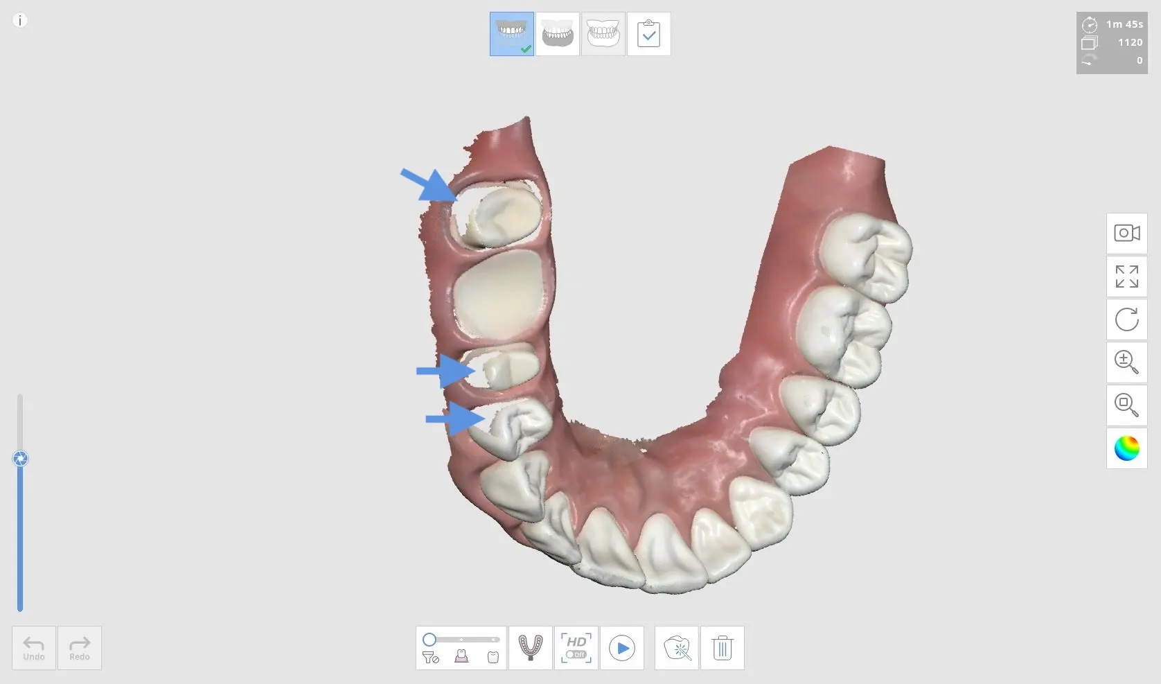 Pre Occlusion 2.webp