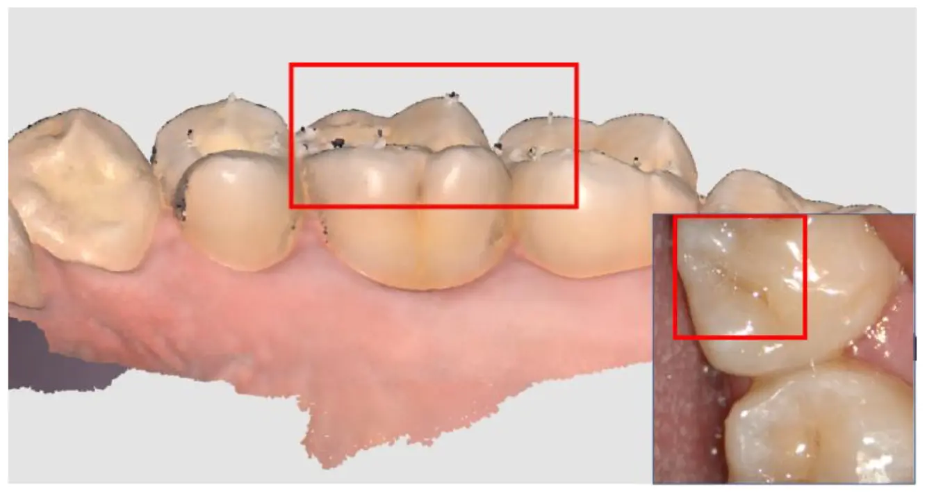 Pre Occlusion 3.webp