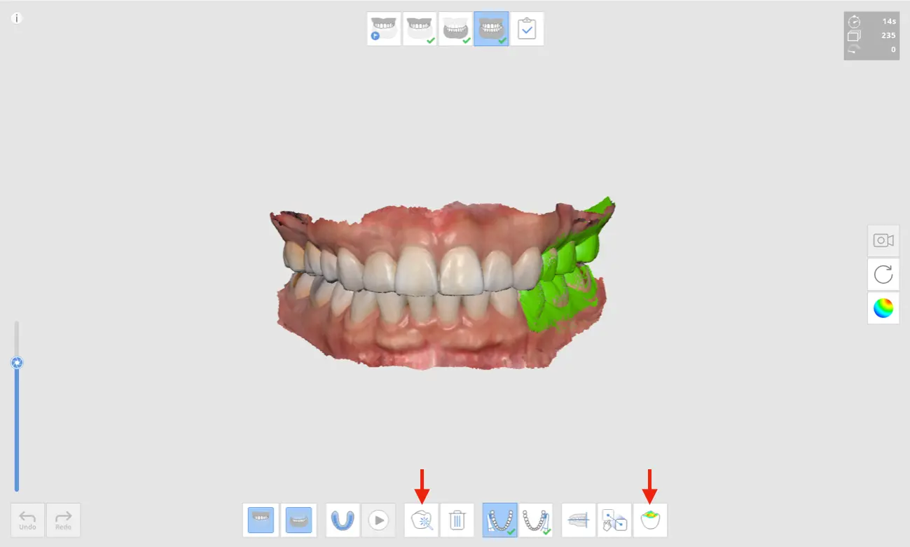Occlusal scan 4.webp