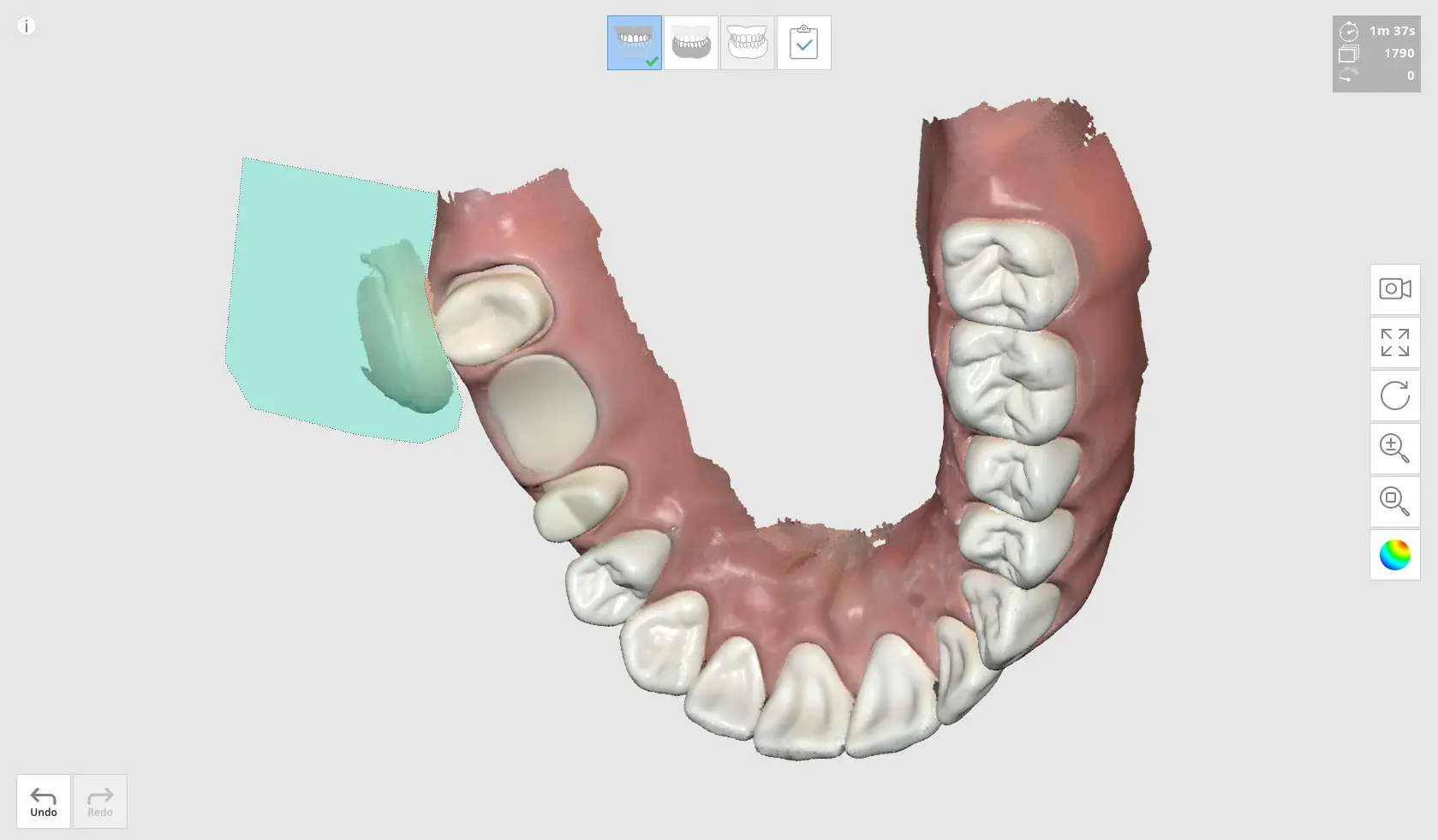 Pre Occlusion 1.webp