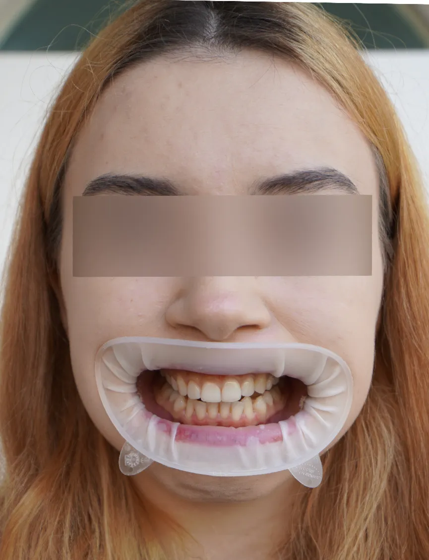 Retracted Mouth Image.webp