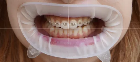 Braces Options 2-1.webp