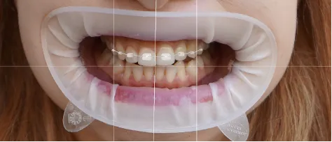 Braces Options 2-2.webp