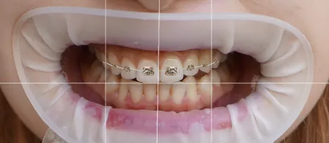Braces Options 4-1.webp