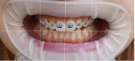 Braces Options 4-2.webp