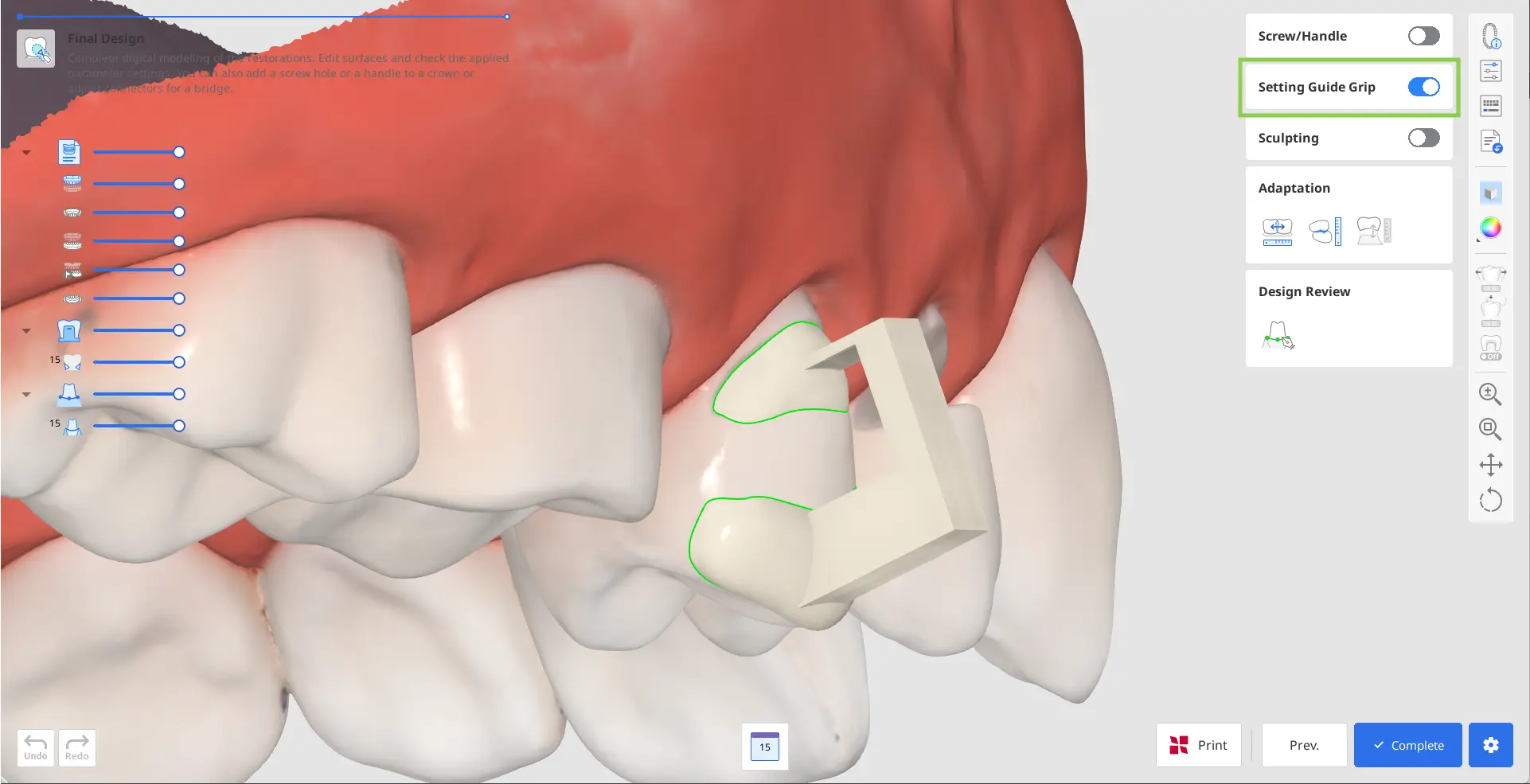 Designing Cervical Inlay 5.webp