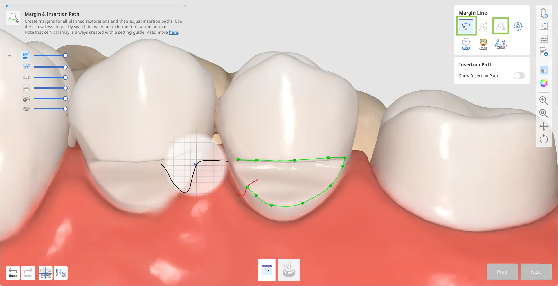 Designing Cervical Inlay 2.webp