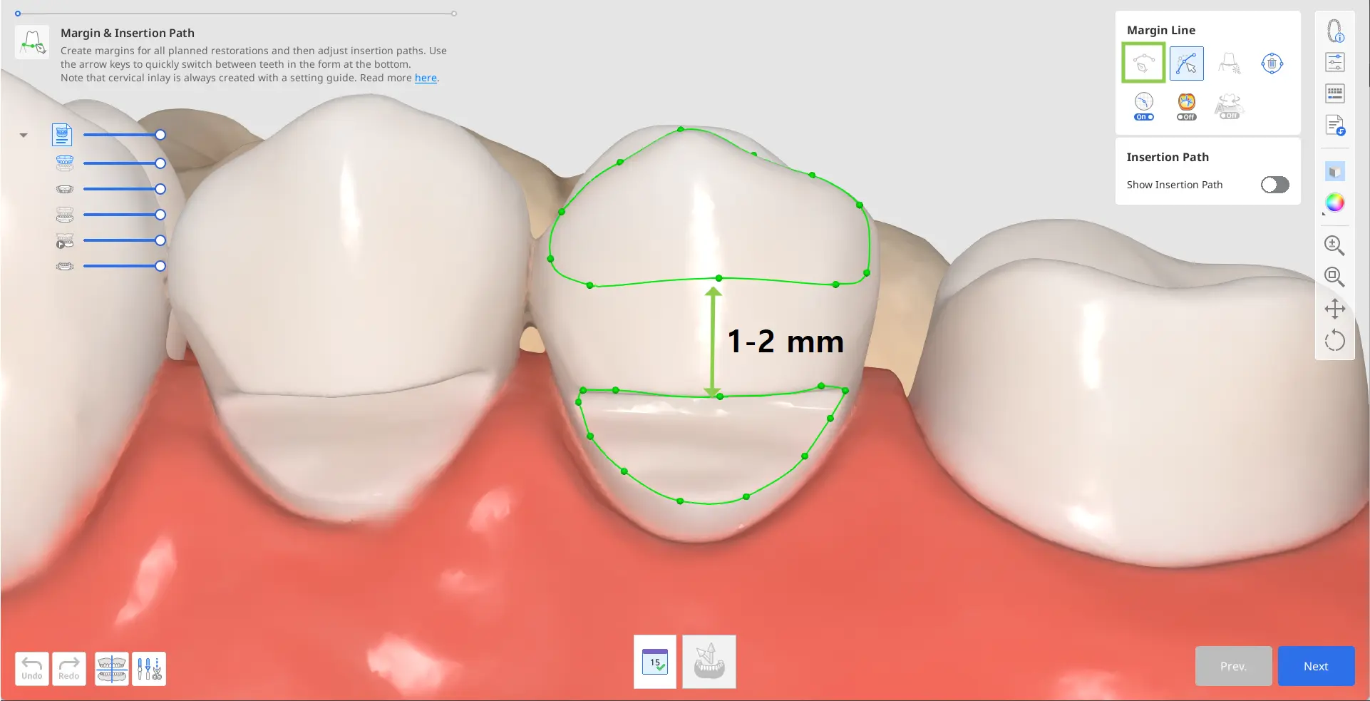 Designing Cervical Inlay 3.webp