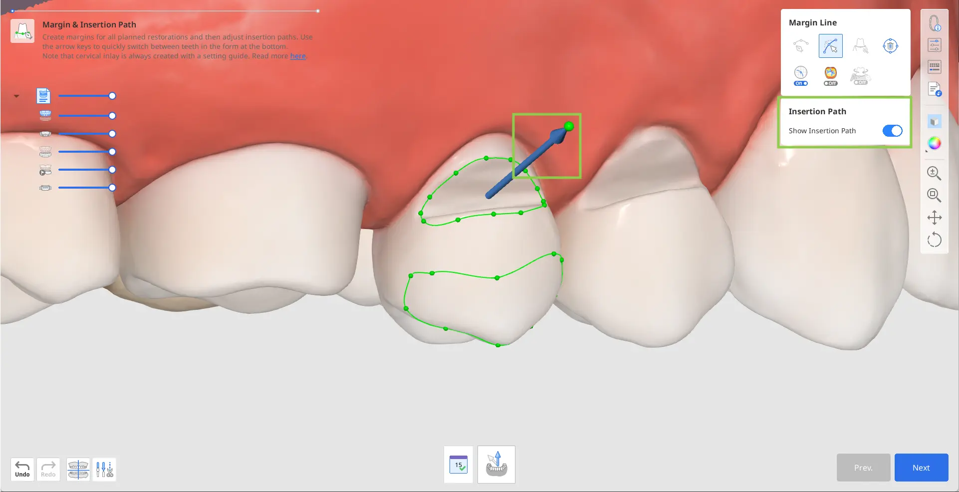 Designing Cervical Inlay 4.webp