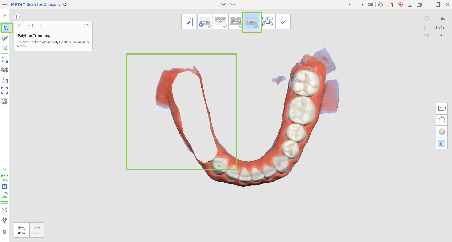 Acquiring the prepared teeth data 1.webp