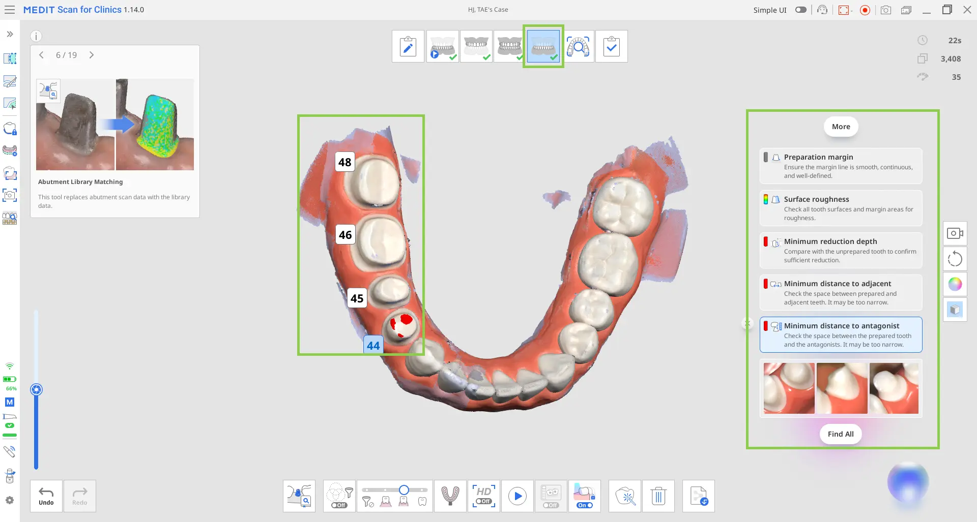 Acquiring the prepared teeth data 2.webp