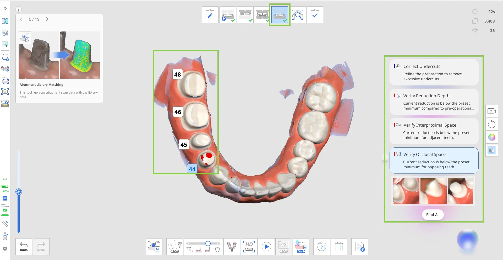 Acquiring the prepared teeth data 1 (1).webp