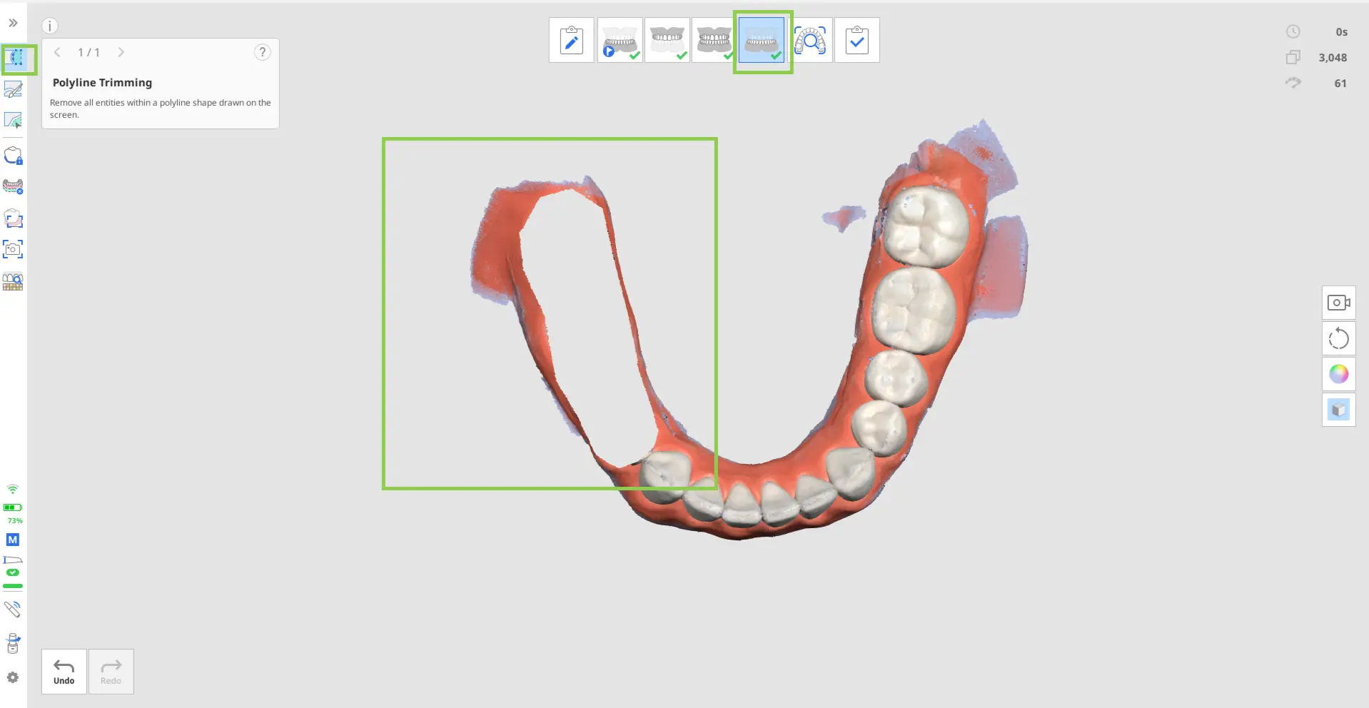 Acquiring the prepared teeth data.webp